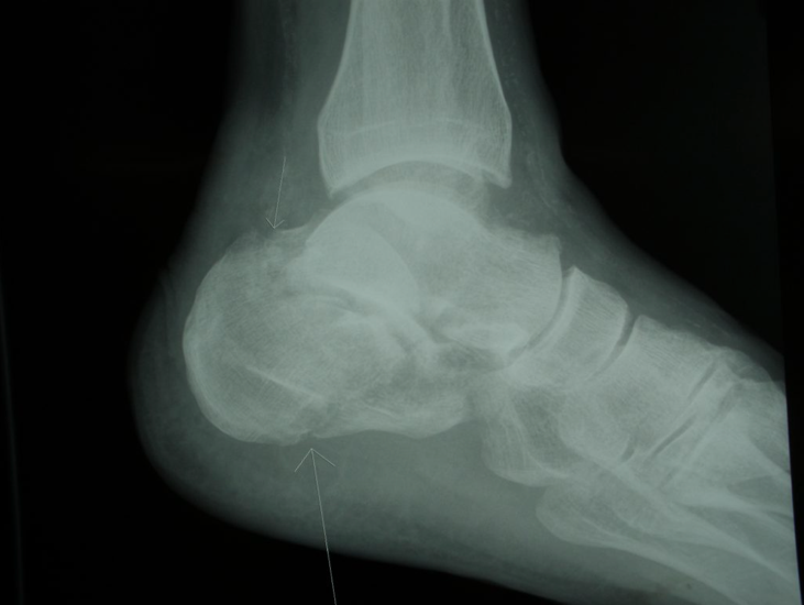 Radiographie montrant une vue de côté (latérale) d’un calcanéus fracturé