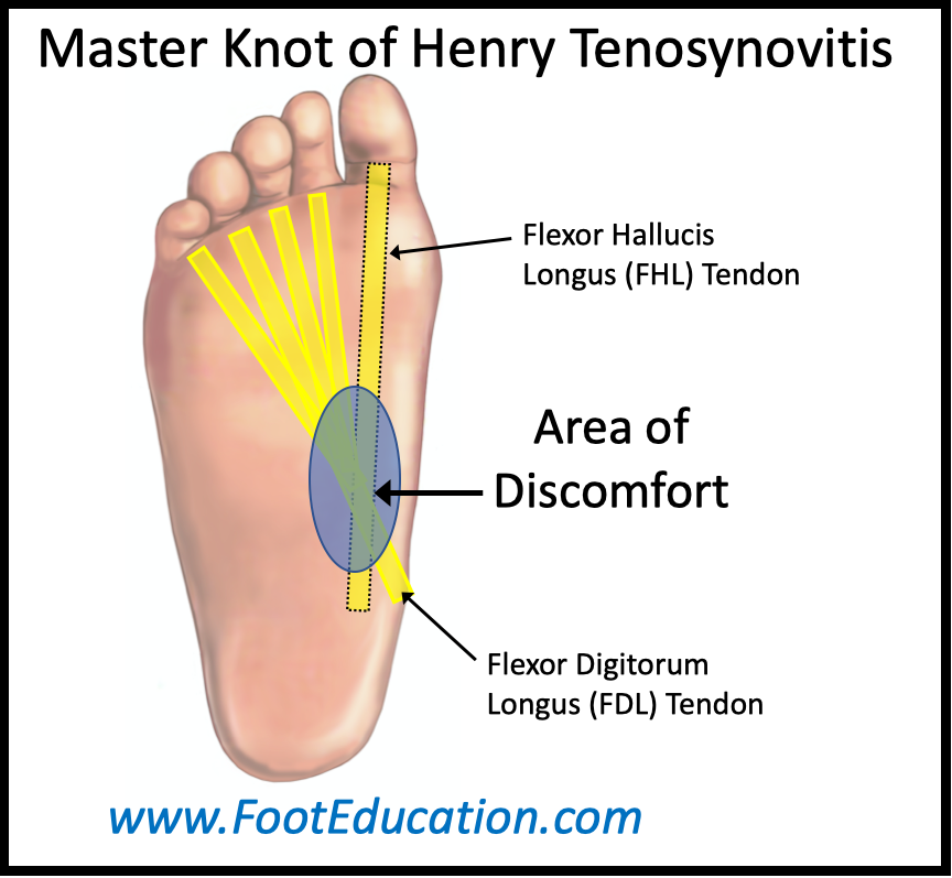 Master Knot of Henry Tenosynovitis