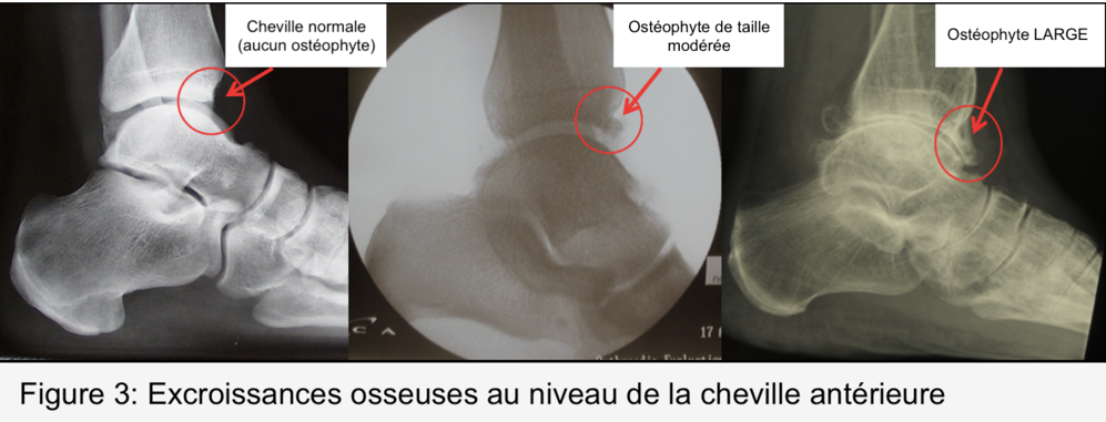 Excroissances osseuses au niveau de la cheville anterieure