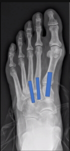 Midfoot Fusion schematic diagram