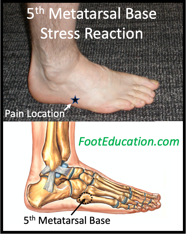 Location of lateral foot pain in Fifth Metatarsal Base Stress Reaction