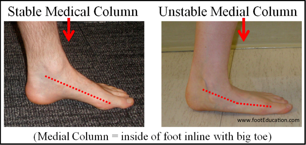 Medial Column Hypermobility causing a Flat Foot