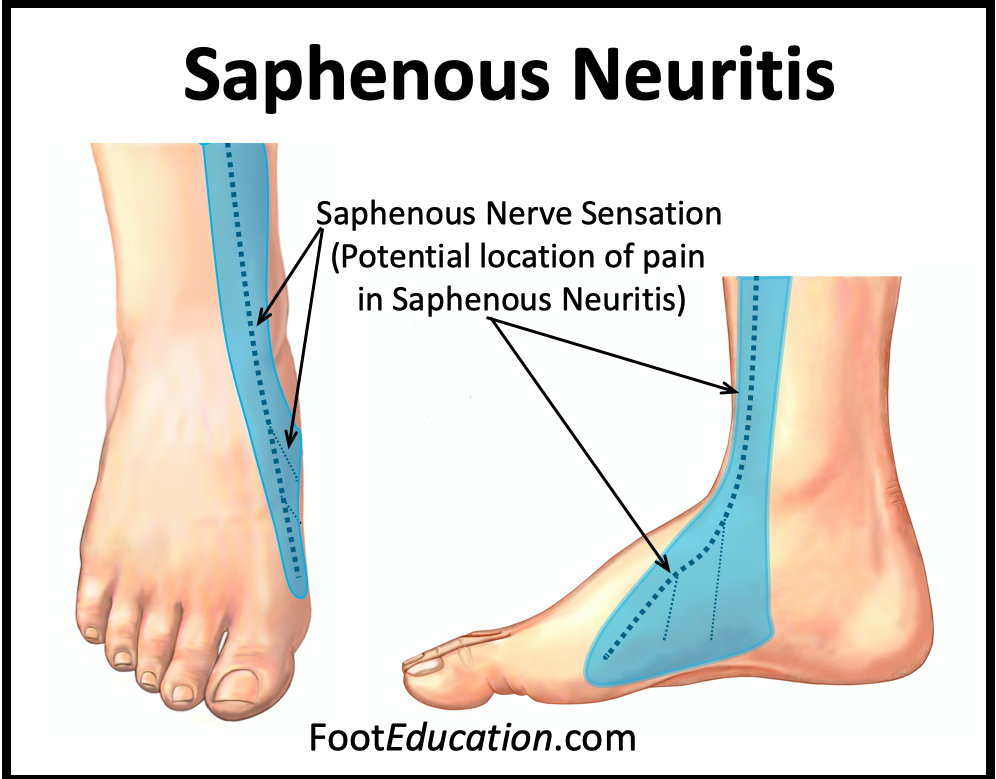 NNerve -Pain Distribution