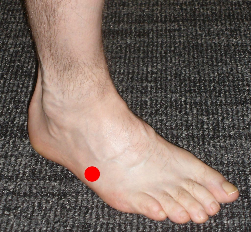 Picture  of the location of pain in 5th metatarsal avulsion fracture