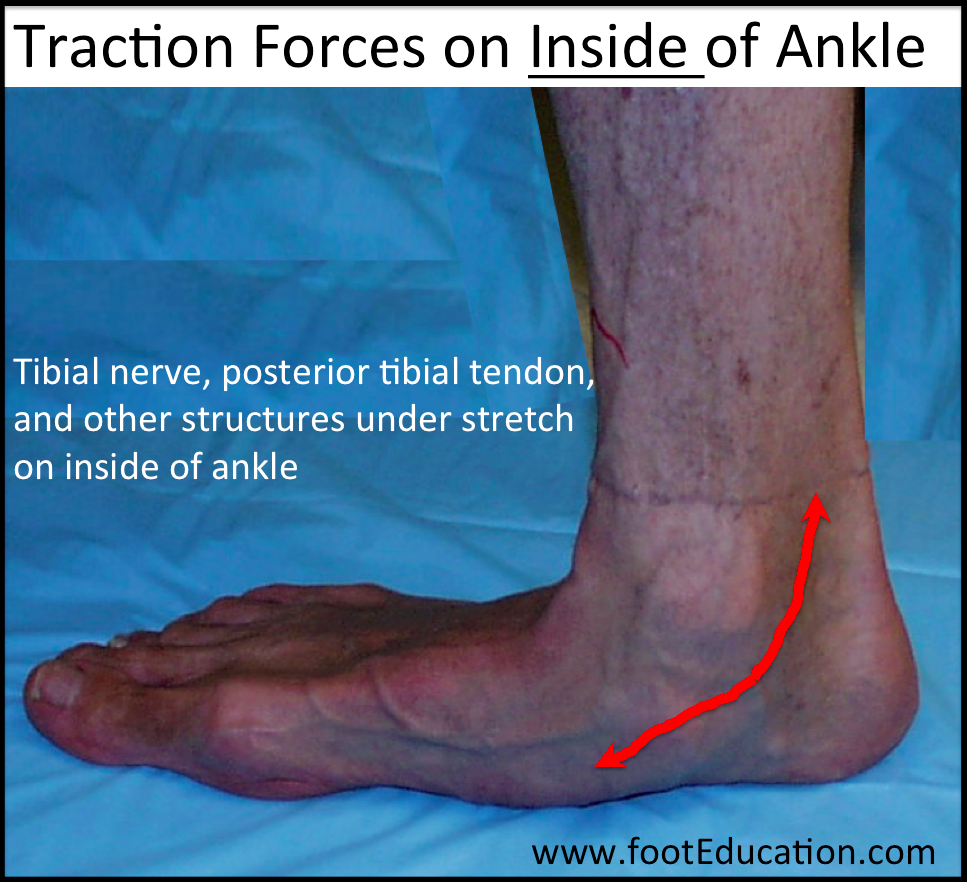 Traction Forces in a Flatfoot