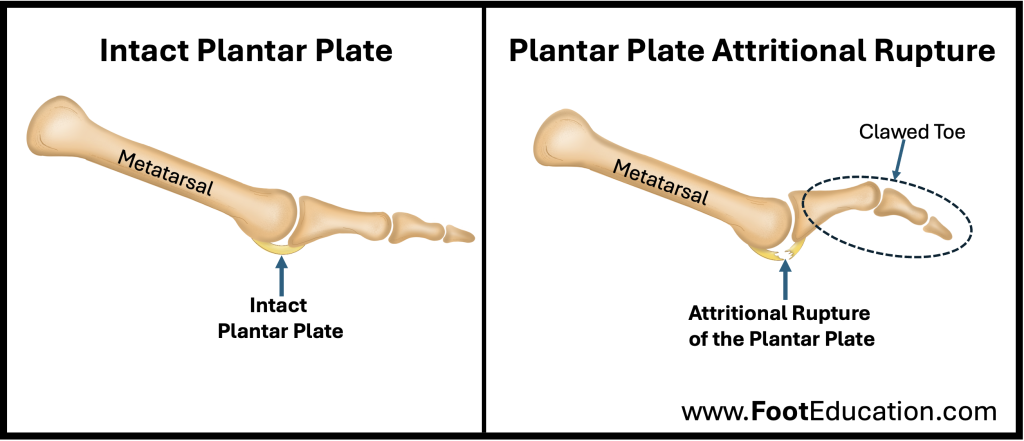 Attritional rupture of a plantar plate -torn plantar plate