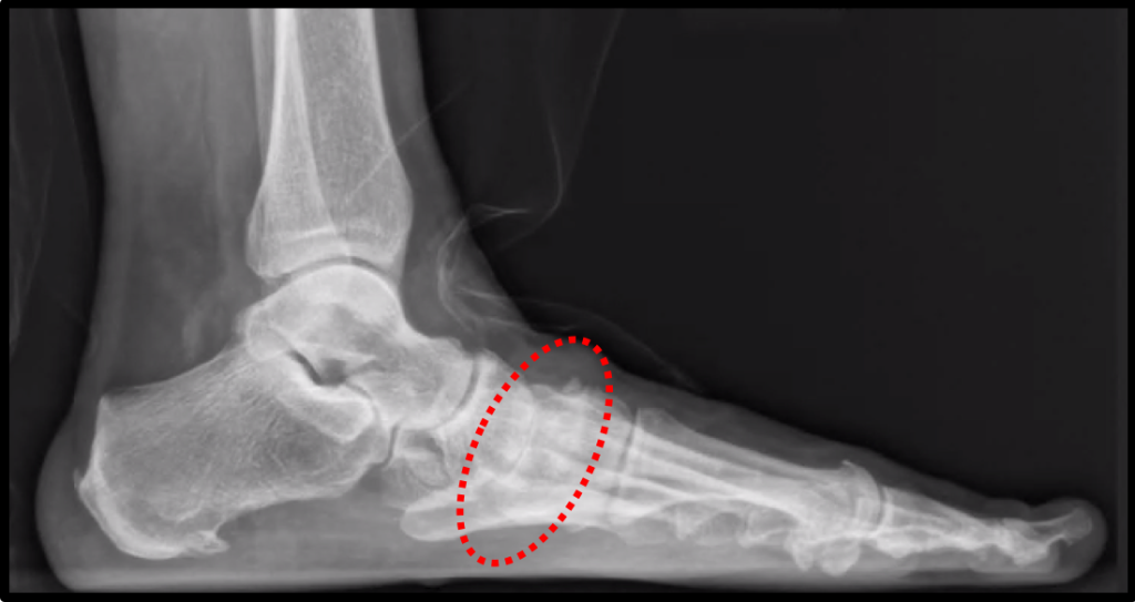 Midfoot arthritis x-ray