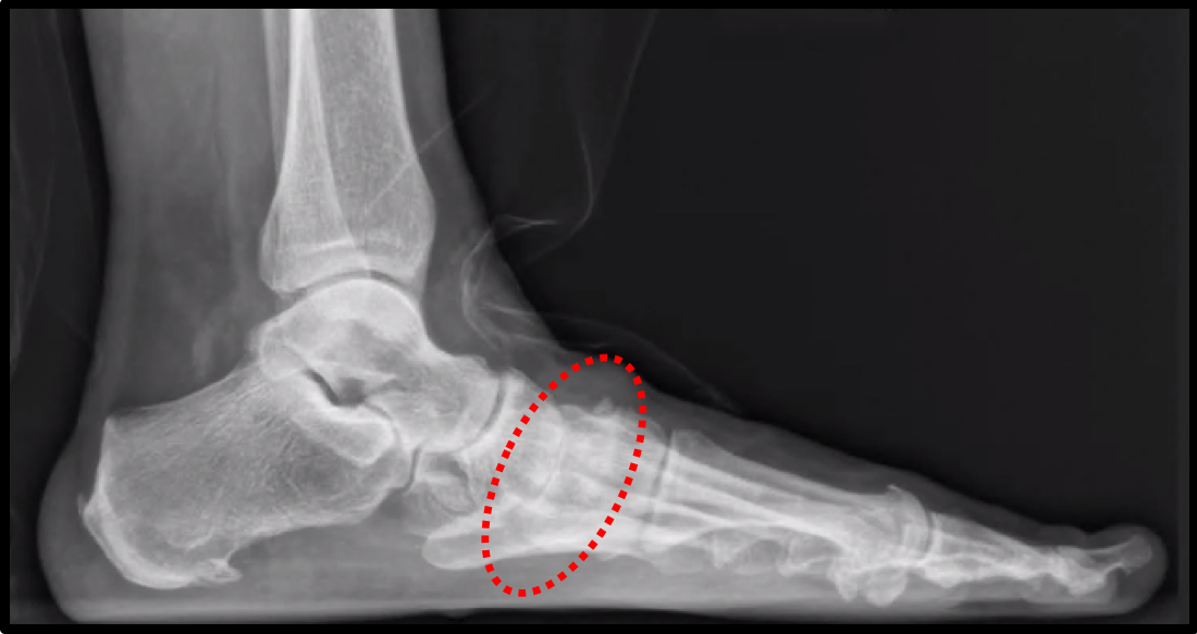 icd 10 code for midfoot arthritis left foot