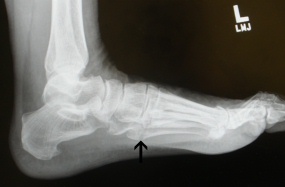 Lateral X-ray demonstrating a 5th metatarsal avulsion fracture