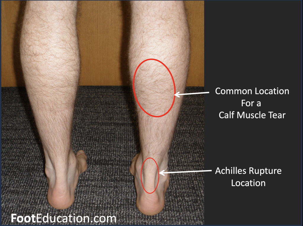 Common Location of Calf Muscle Tear