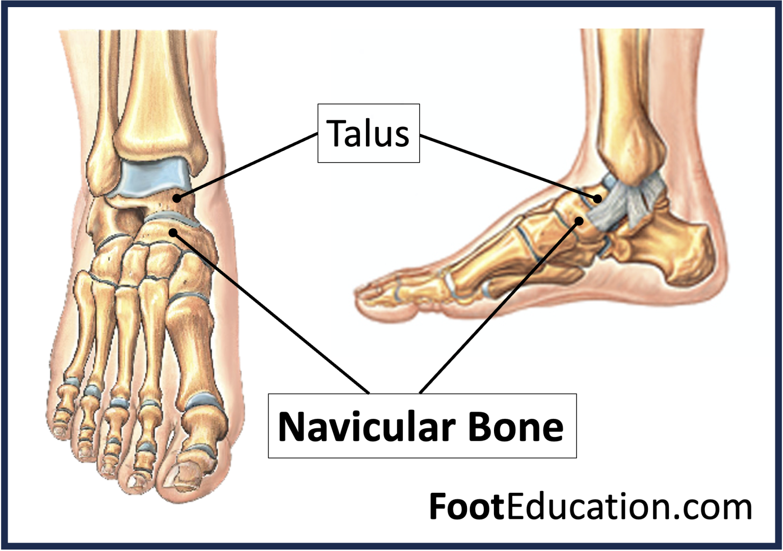 Lateral Navicular Mueller-Weiss Disease - FootEducation