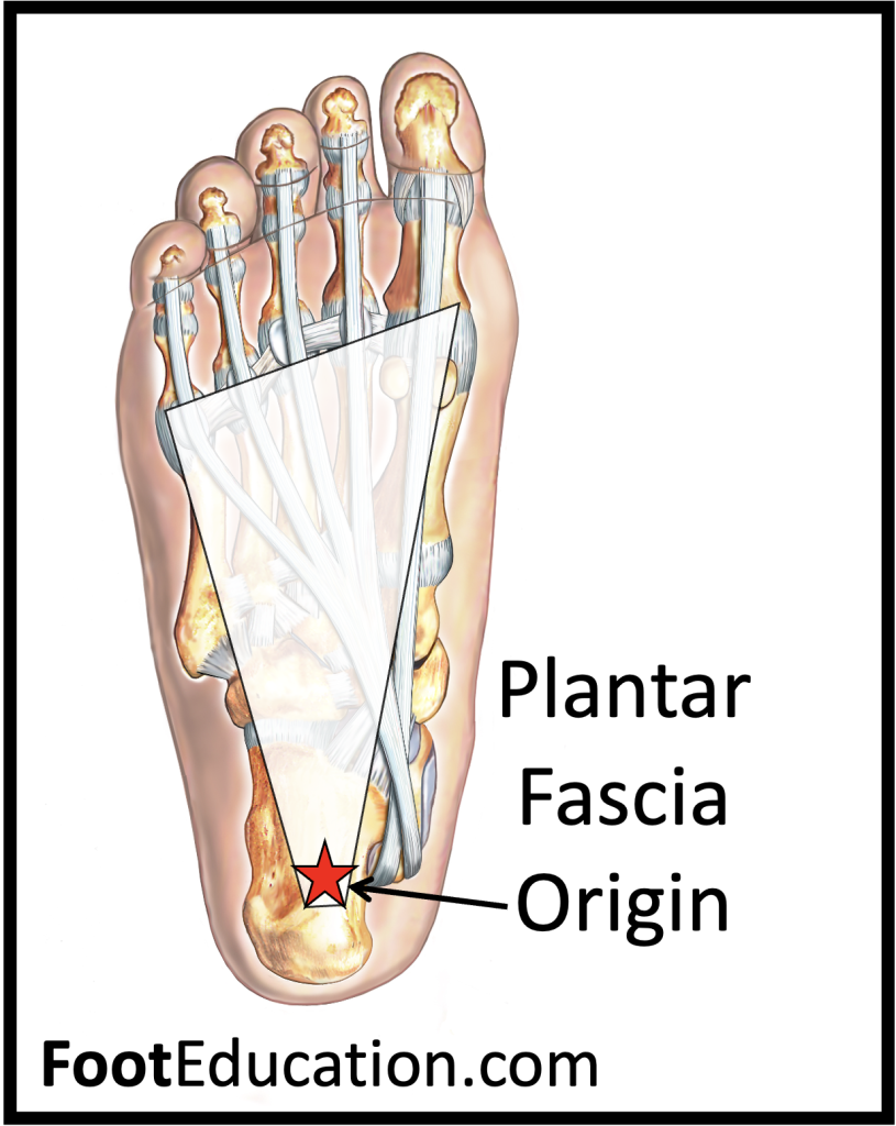 Common Location of Plantar Fasciitis Pain