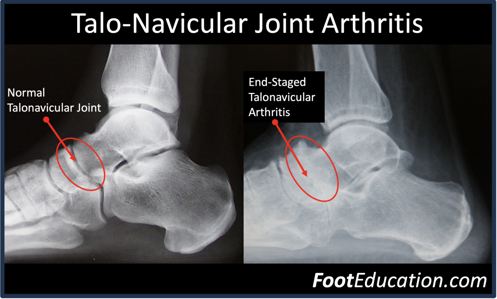  Lateral X-Ray of 
 Normal Joint and Talonavicular Arthritis 