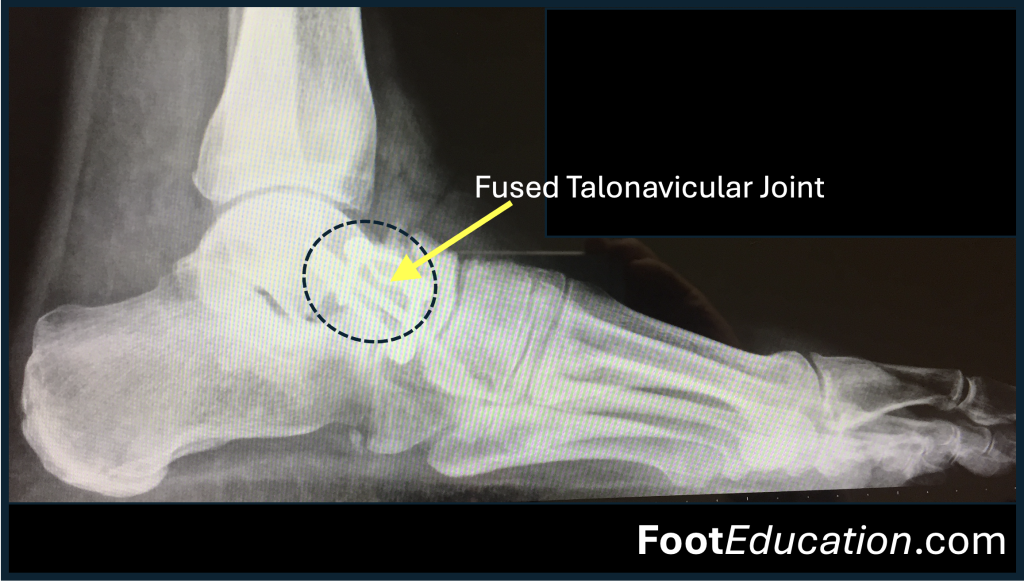 X-ray of Talonavicular Fusion