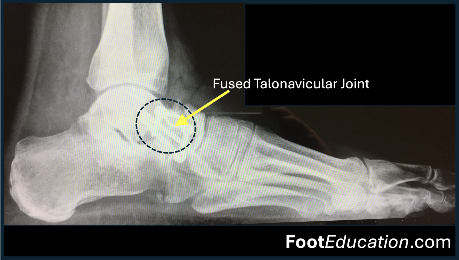 talonavicular fusion icd 10