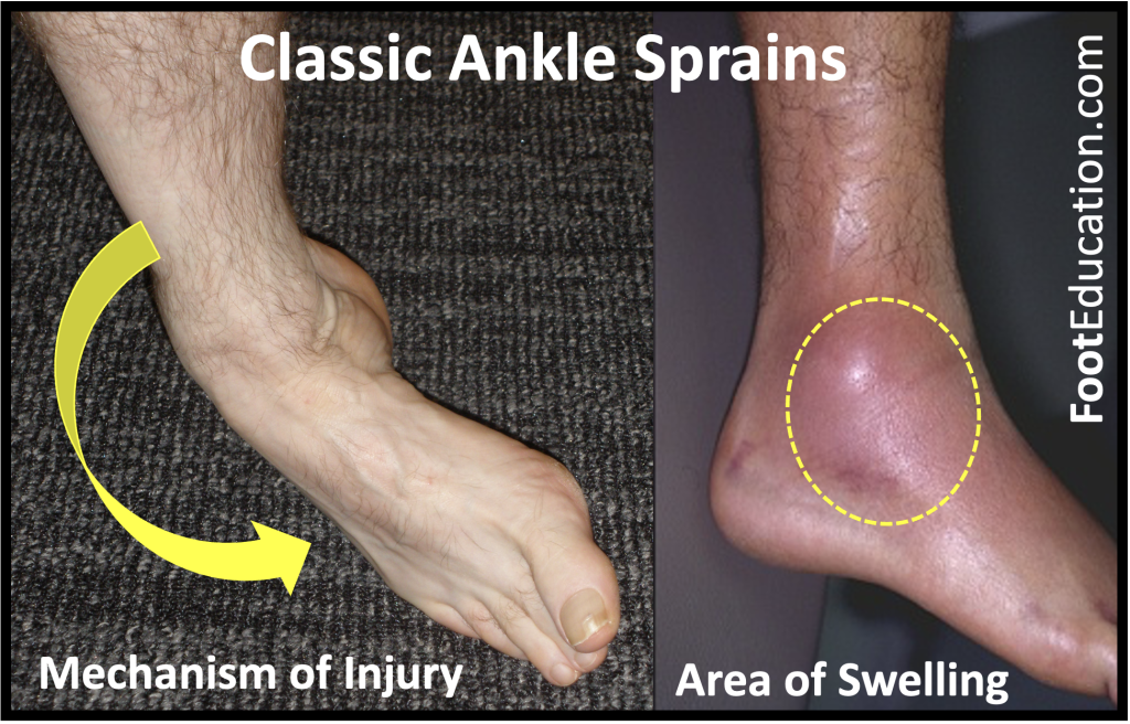 Classic Ankle Spain Mechanism of Injury and Swelling