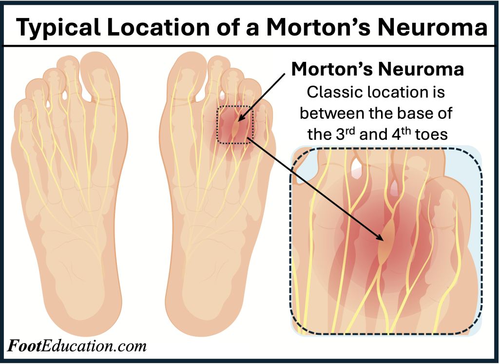 Classic Location of a Morton's Neuroma