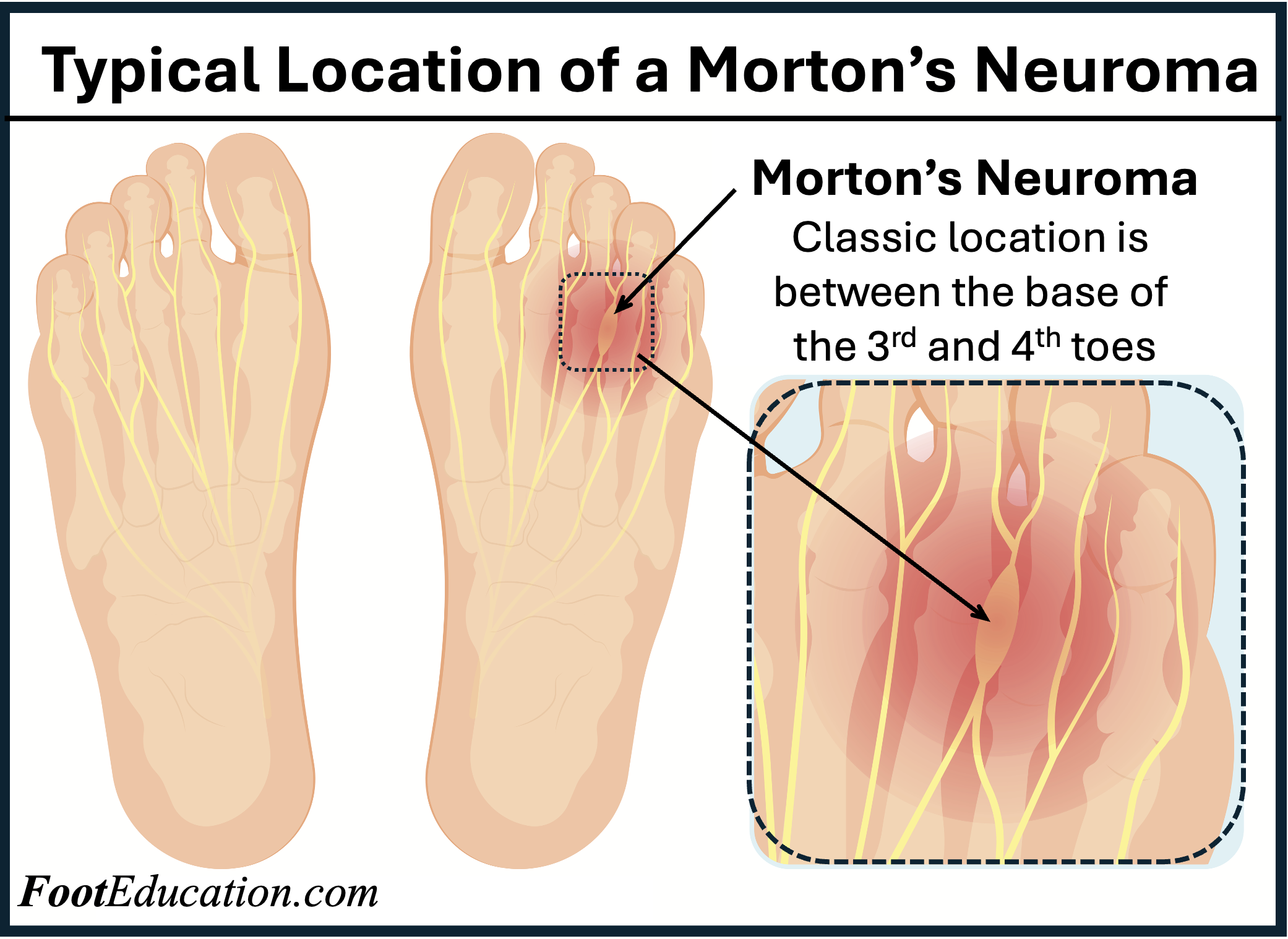 Mortons Neuroma Mortons Neuroma