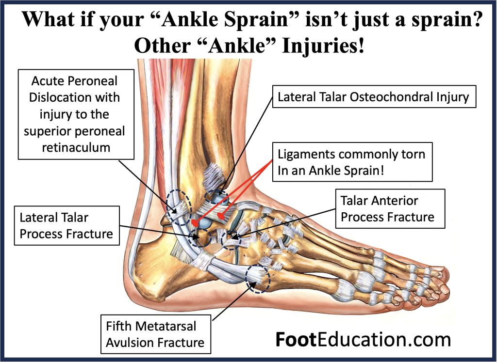 When your ankle sprain is not an ankle sprain -otehr possible ankle injuries