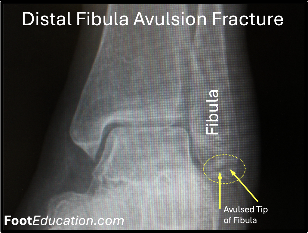 X-Ray of Distal Fibular Avulsion Fracture