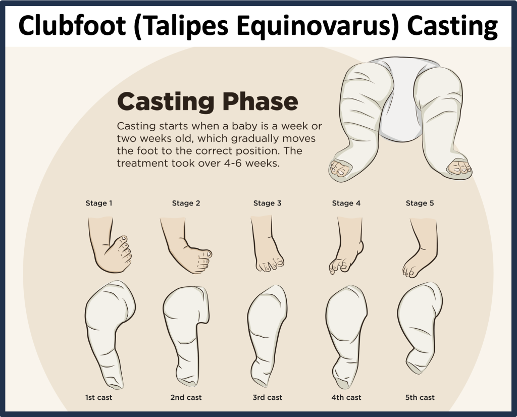 Illustration of Clubfoot Casting