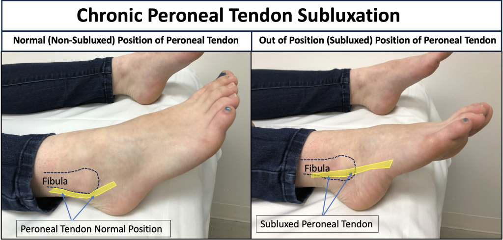 Photos demonstrating chronic peroneal tendon subluxation