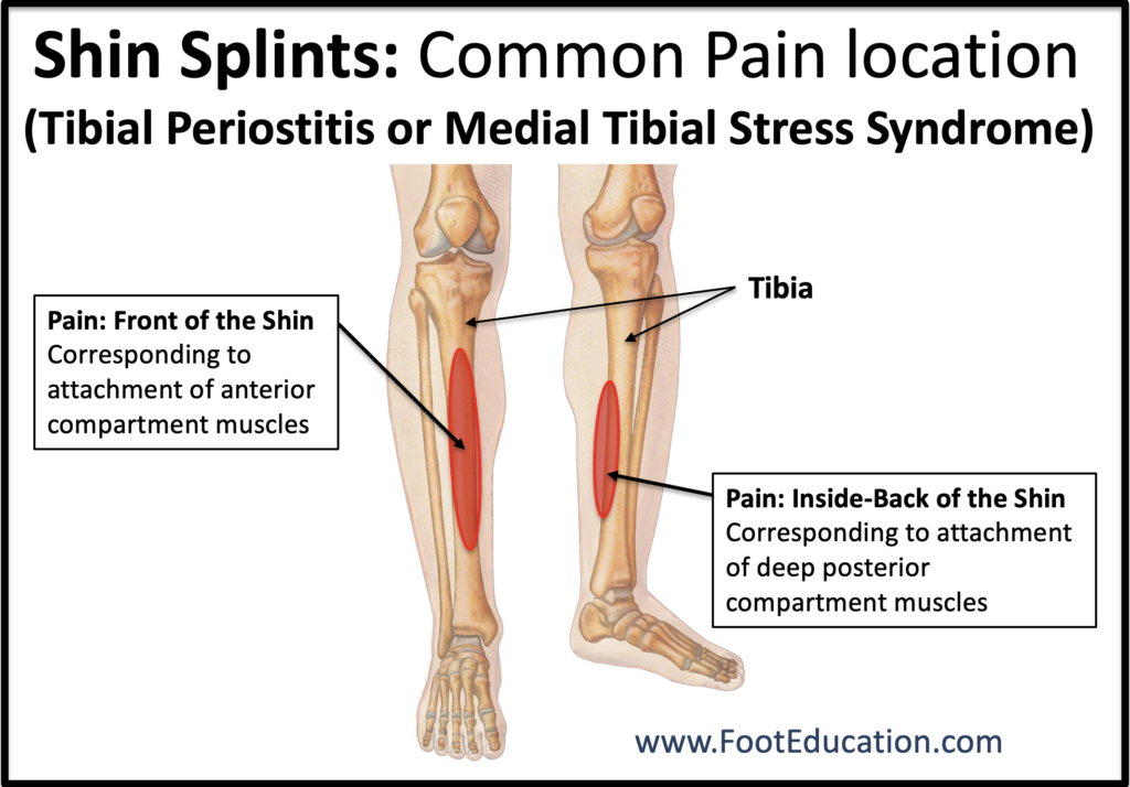 Illustration of the common pain locations in shin splints