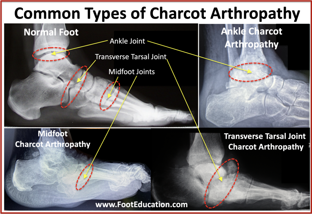 Common Types of Charcot Arthropathy