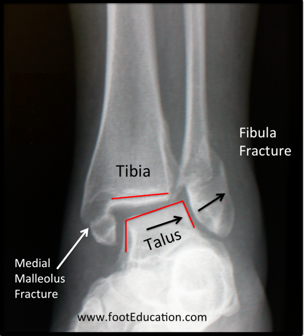 Plain-X-Ray of an Unstable Ankle Fracture