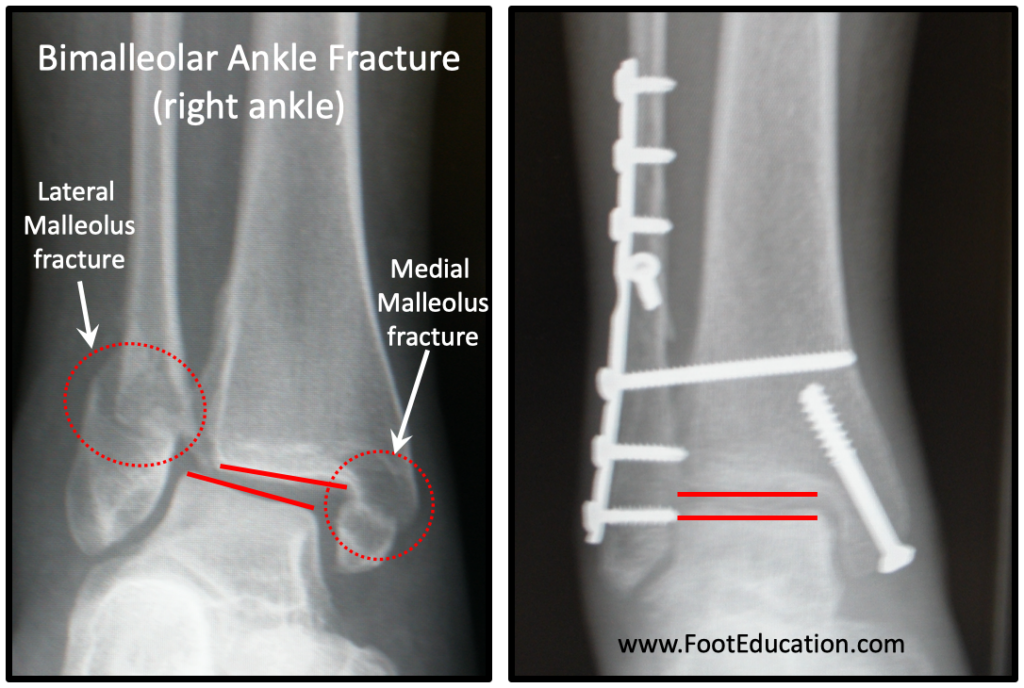 X-rays of a Unstable Bimalleolar Ankle Fracture with and without Fixation